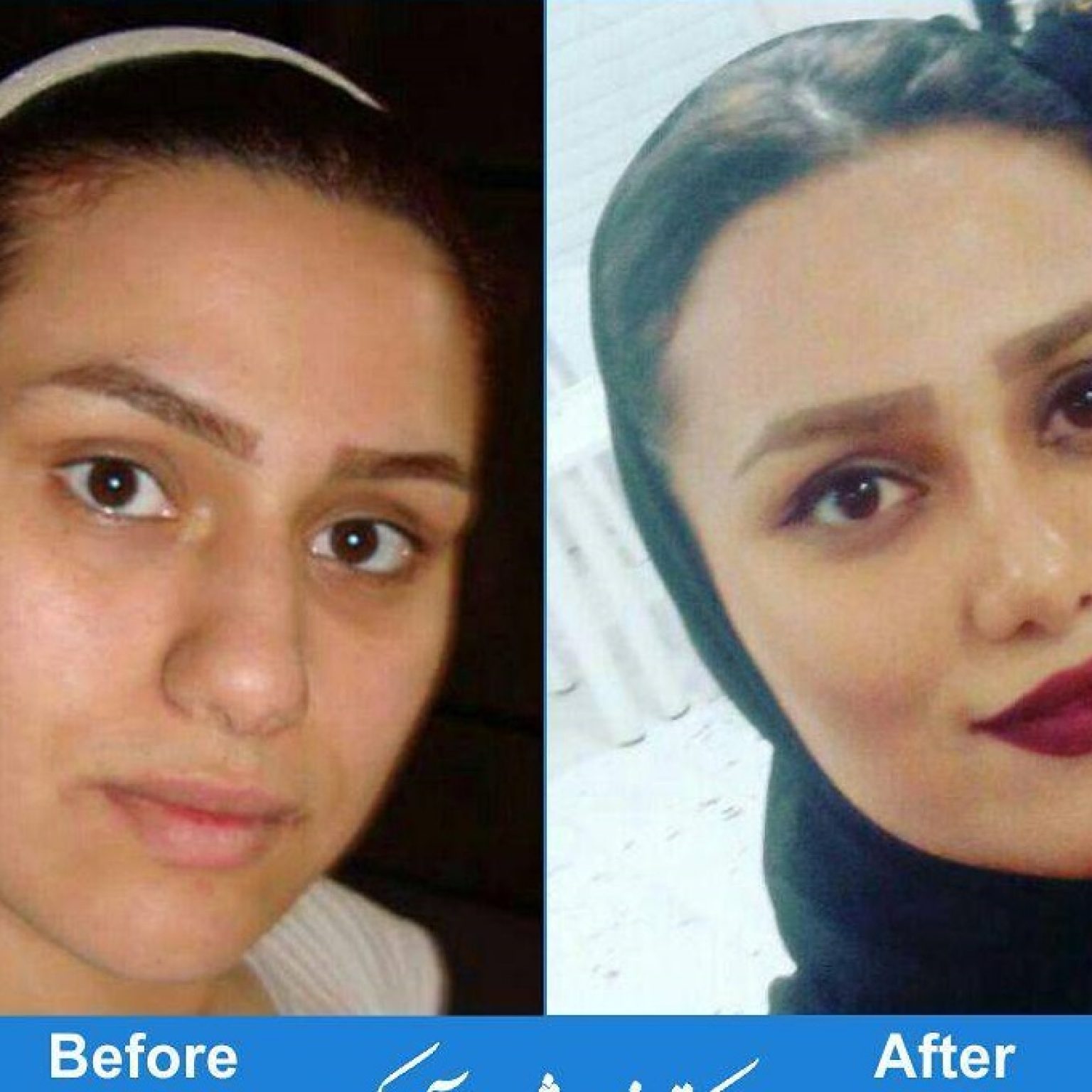 Nose Job In Iran Best Hospitals And Prices Friendlyiran 9579